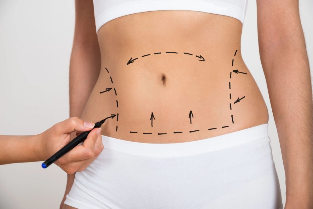 Tummy Tuck Recovery Timeline
